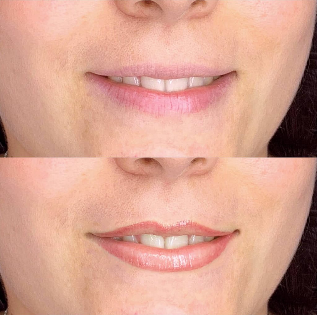 Trucco Permanente - Permanent Makeup Labbra Prima & Dopo